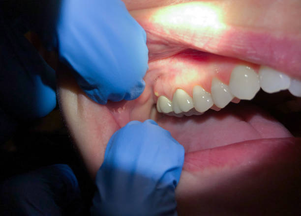 Best Emergency Root Canal Treatment in Troy, TX